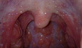 吃瓜之后感觉喉咙,揭秘喉咙不适的奥秘